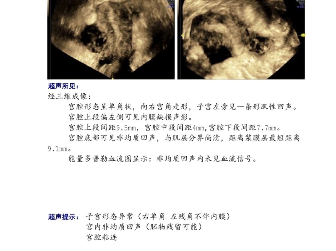 宫腔粘连严重吗必须手术吗