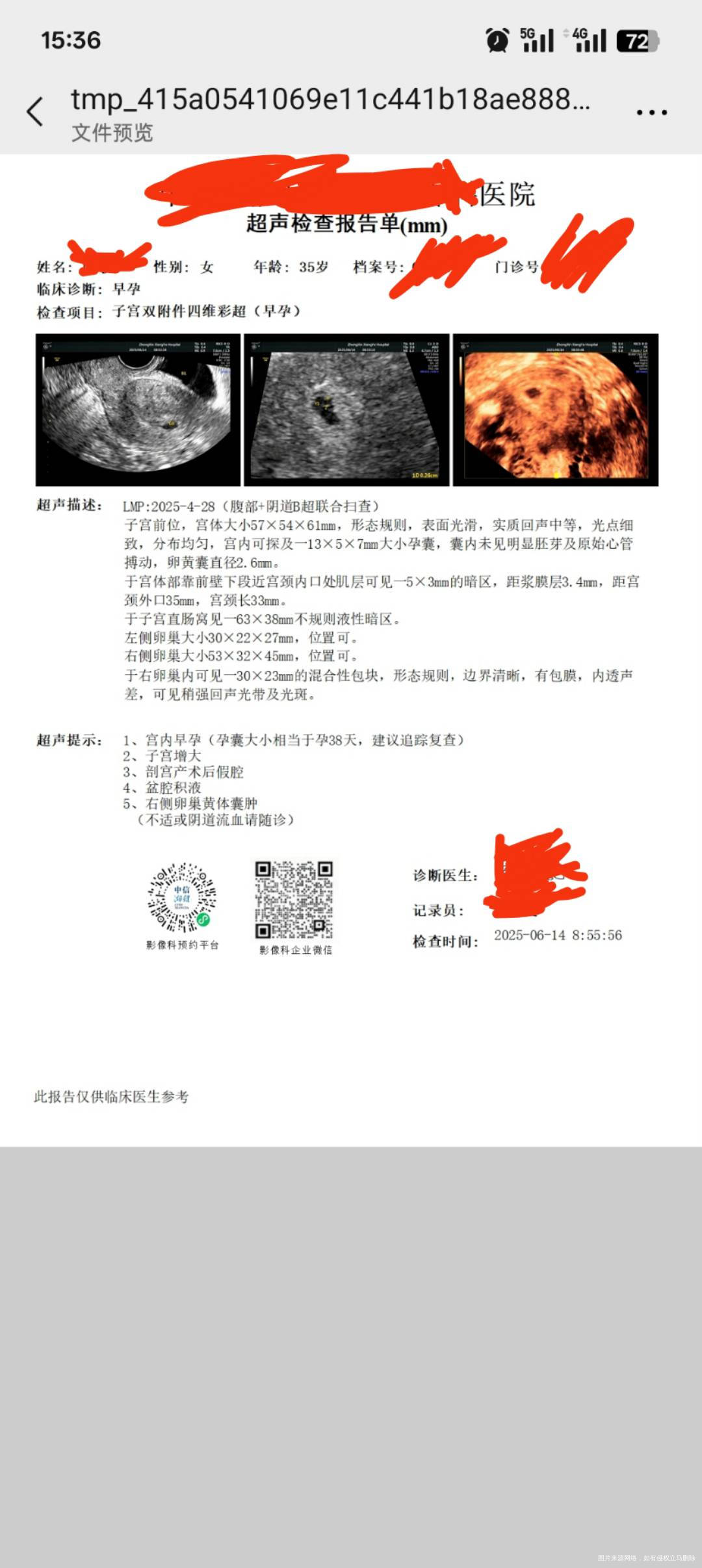 您好请问一下以前多囊卵巢结婚一年怀孕一次人流