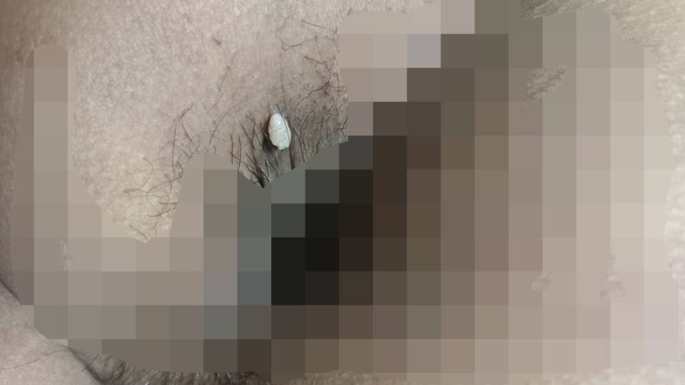 请问这是什么是尖锐湿疣吗长在男性肛周且就这一