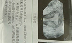 我这种情况做宫腔镜恢复的概率有多大