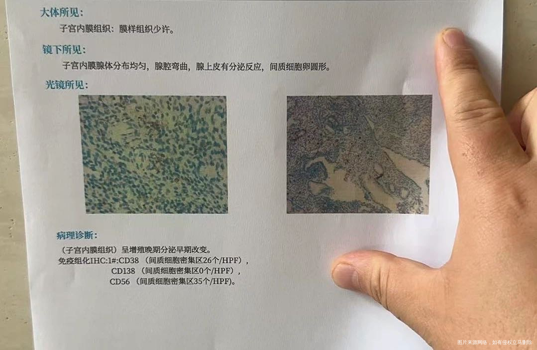 你好帮忙看看病理报告CD38和CD56高外周