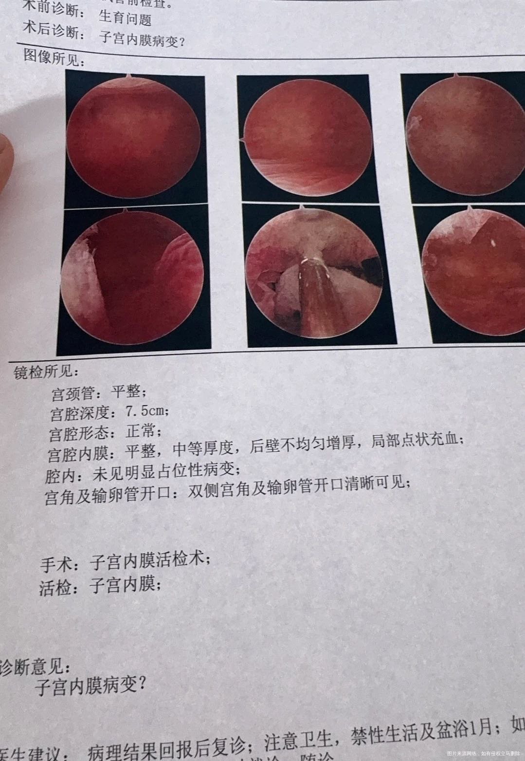 你好帮忙看看病理报告CD38和CD56高外周
