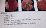 你好帮忙看看病理报告CD38和CD56高外周