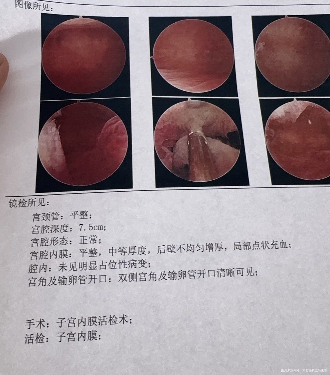 病理报告CD38和CD56高帮忙看看