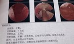 病理报告CD38和CD56高帮忙看看