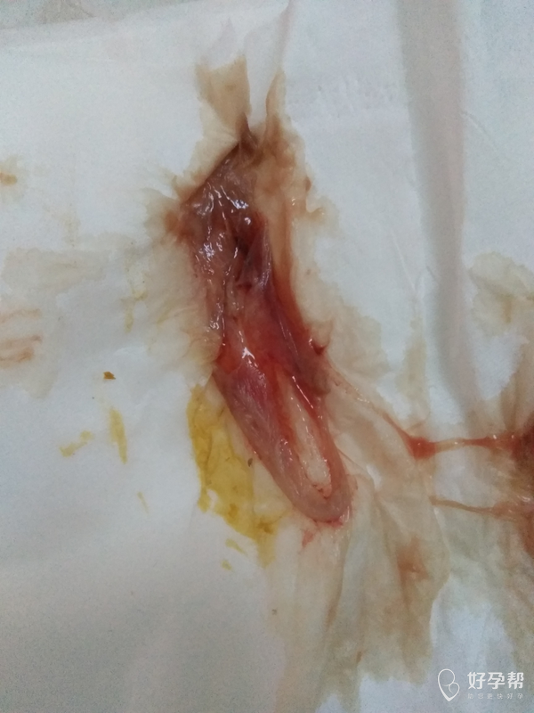 有谁知道生化妊娠是什么样的吗