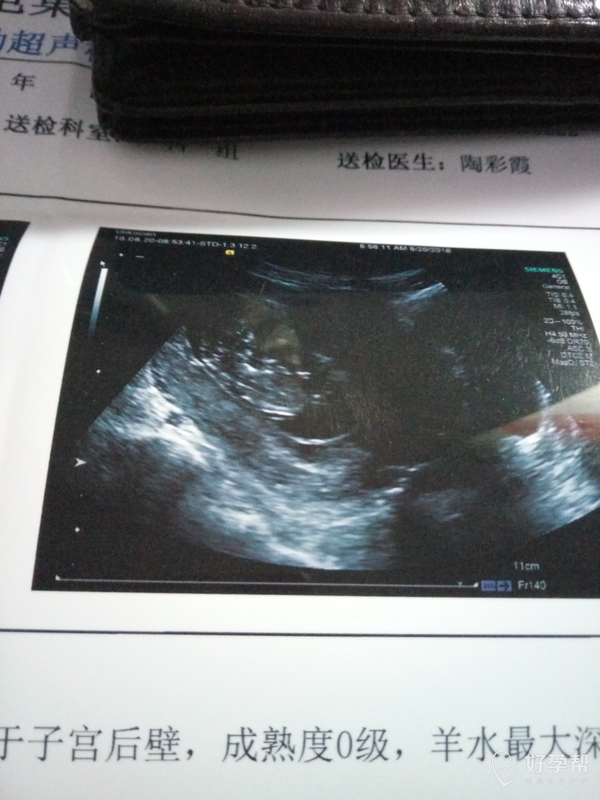 11周 3的b超,偏小吗,宝宝的第二张照片