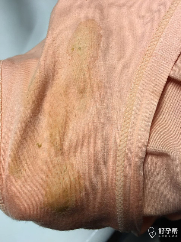 做完阴超后,白带就这样了,正常吗