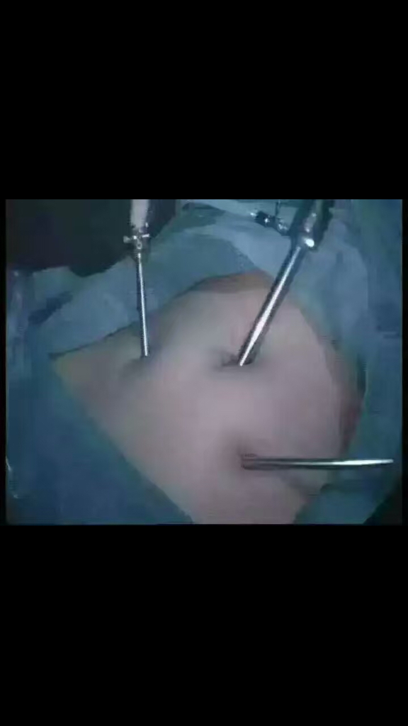 下面这幅图片是女人输卵管堵塞,做宫腹腔镜手术的图片!
