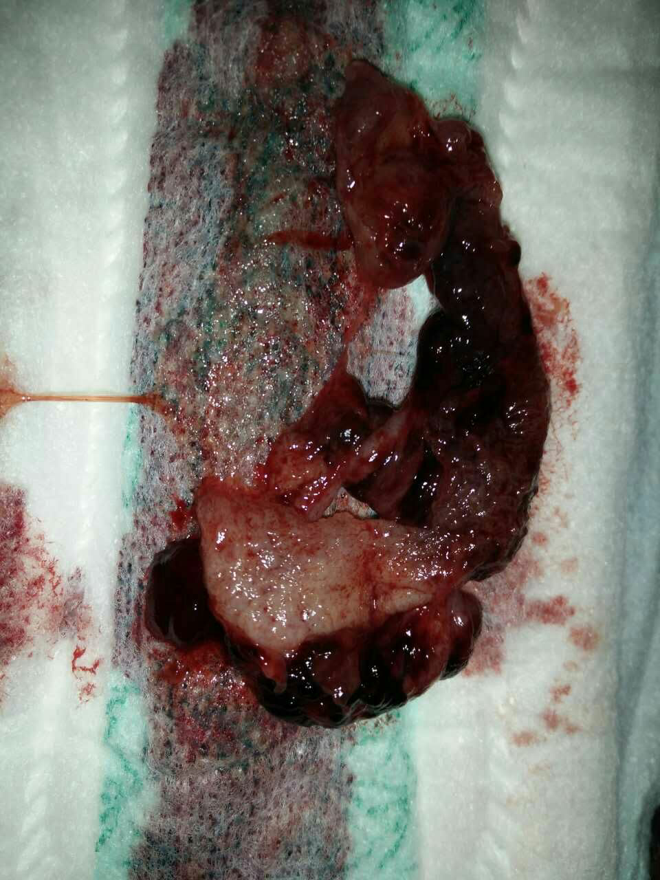 六周流产胚胎图片图片