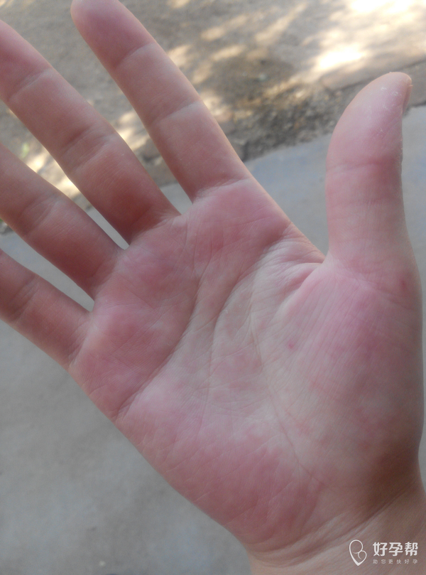 手掌上每到夏天就起红点点