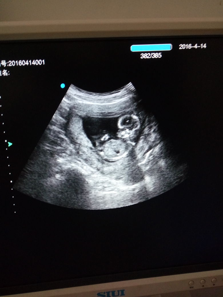 三个月胎儿彩超图片
