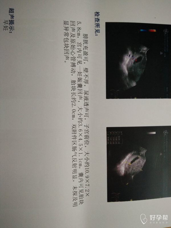 怀孕55天热乎乎的胎心看彩超男孩女孩呢