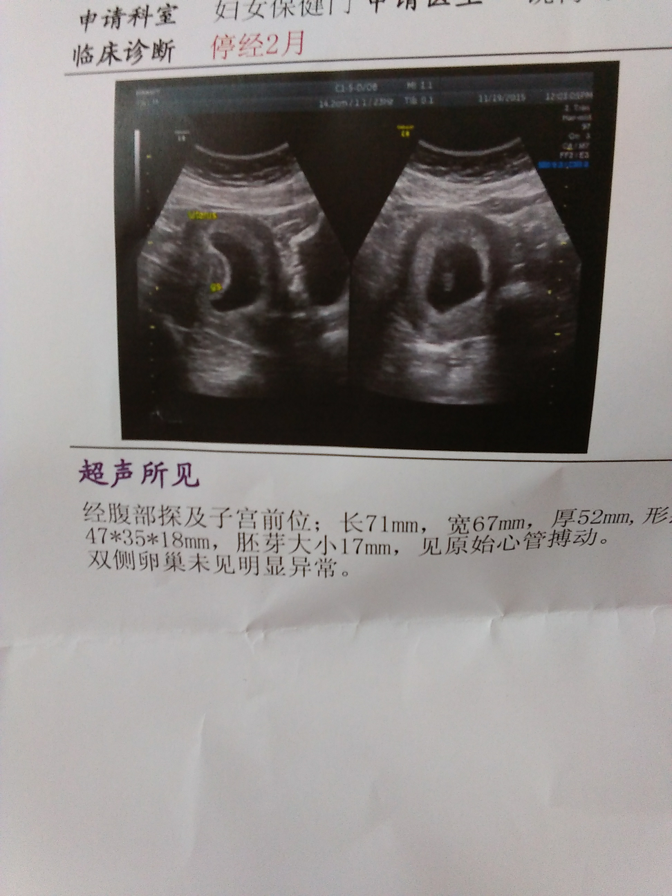 怀孕60天男孩孕囊图片图片