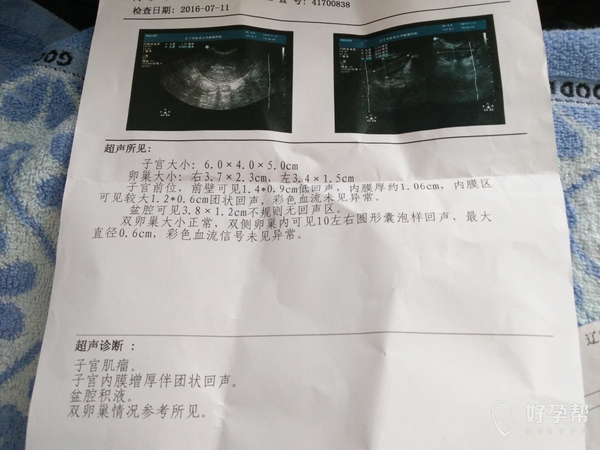 什么叫做多囊卵泡 gw-topic