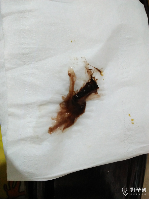 这个是不是宝宝掉了啊!急急急-生化妊娠-难孕治疗论坛-好孕帮