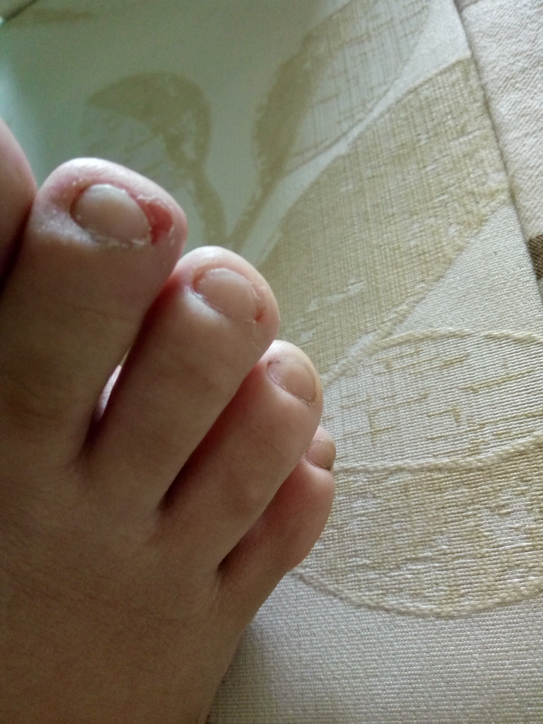 脚趾甲这样了好疼有图慎入