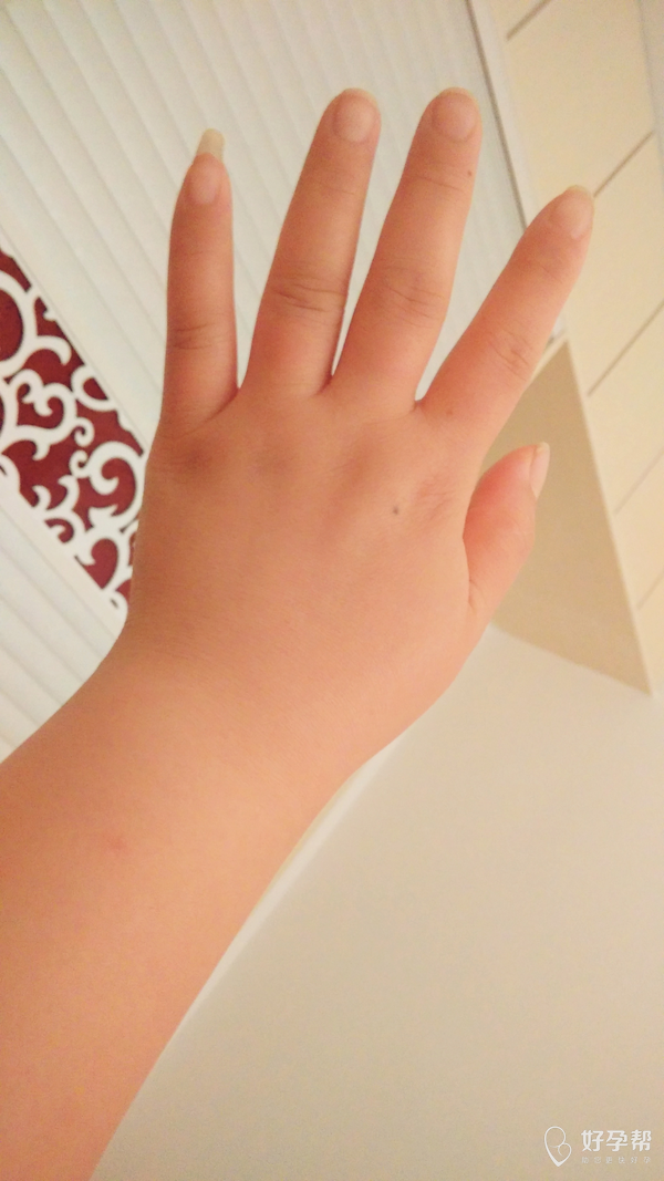 有没有姐妹孕期手也肿的