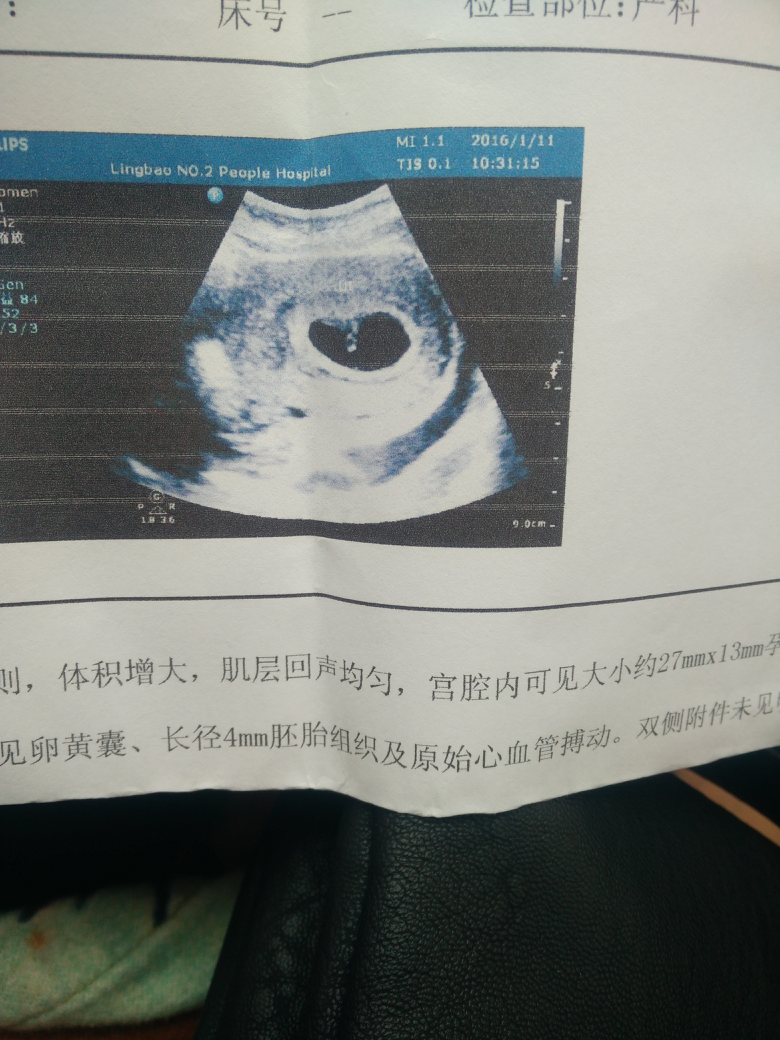 胎囊2个数据是男孩图片