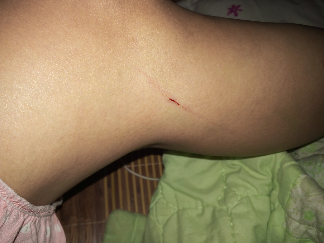 今天在街上腿被人家刮伤了好疼