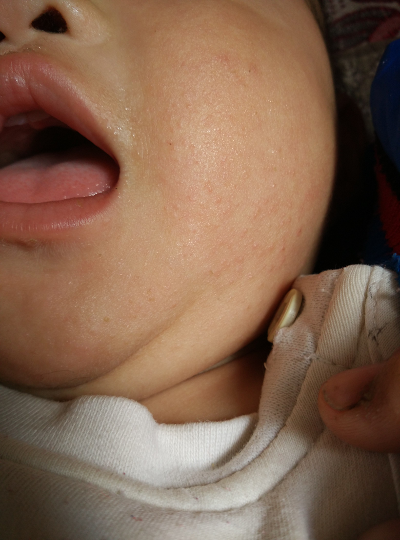 宝宝奶粉过敏症状图片