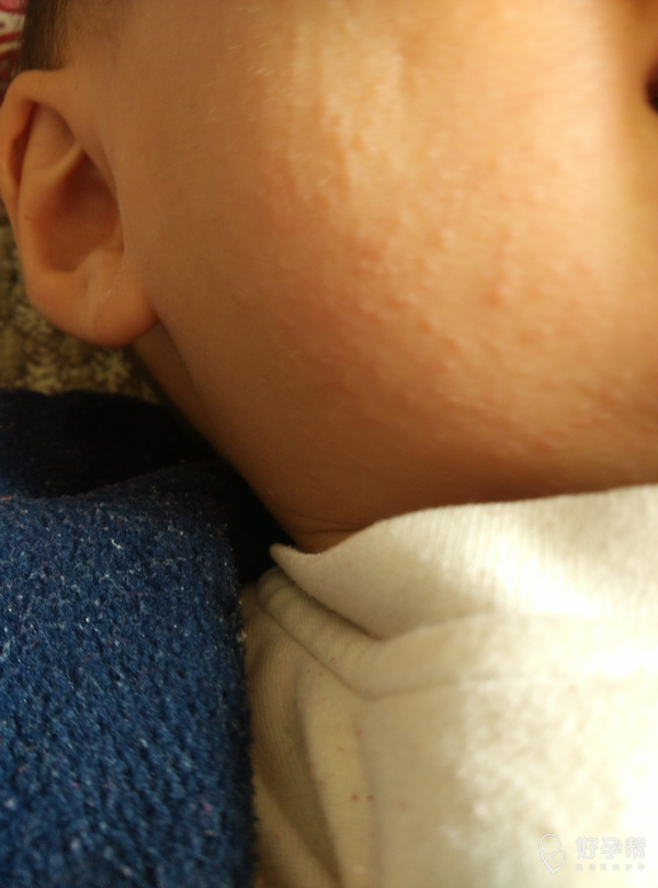 宝宝脸上起的是什么?是过敏还是什么?
