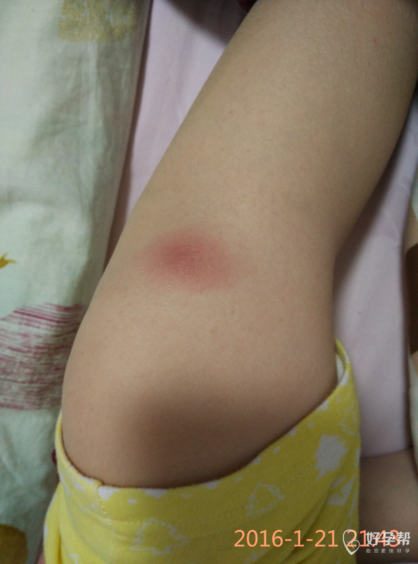 腿上长了个包有没有宝妈提供经验啊