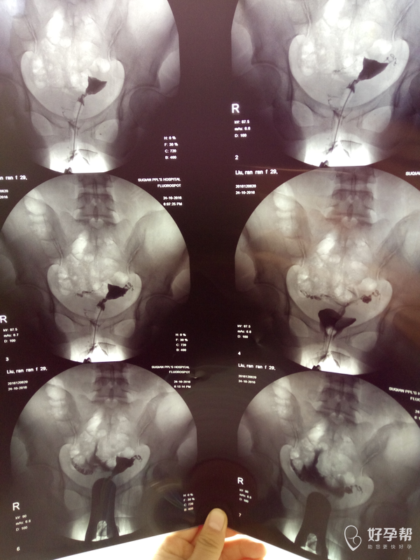 造影回来说是输卵管不通麻烦医生给看一下