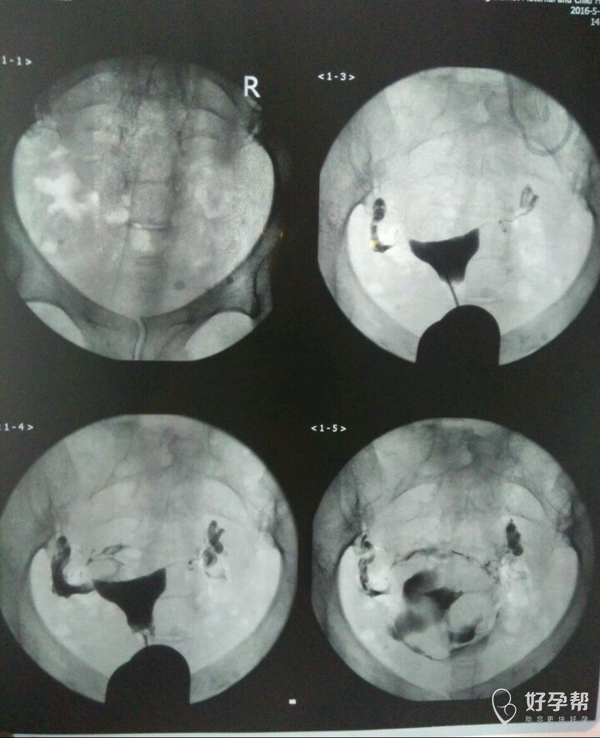 输卵管堵塞可以不做手术嘛听说灌肠也行的