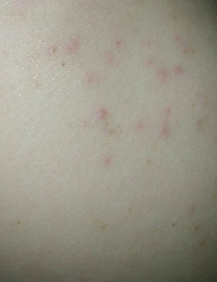 屁股长好多好多痘痘啊,医院拿药也治不好怎么办?-备孕交流圈-好孕帮