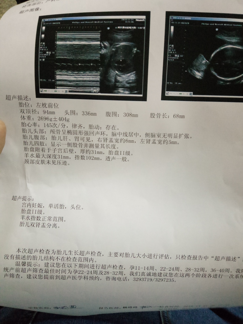 四維檢查雙腎盂分離現在36周了還是雙腎盂分離