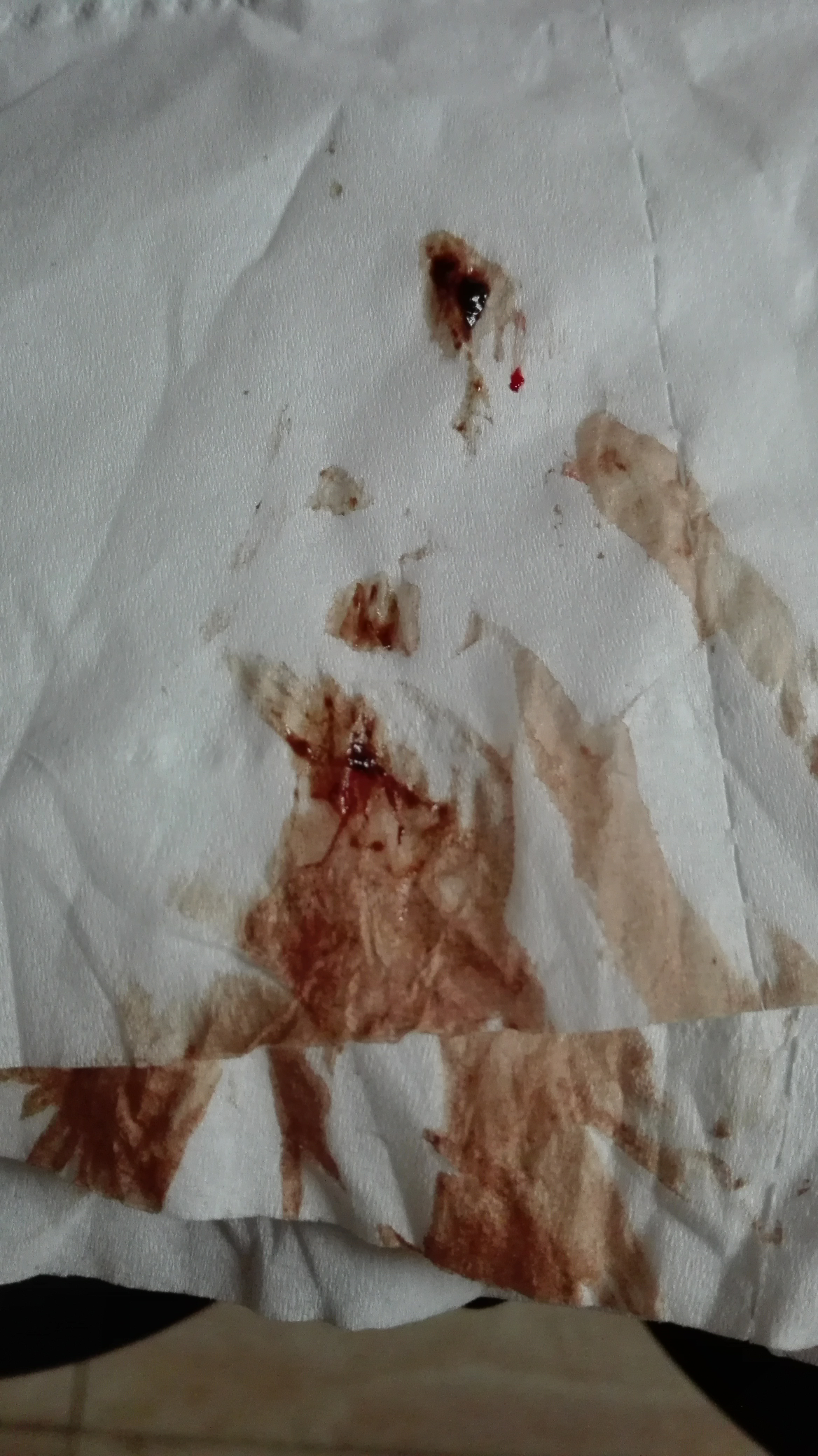 今天走路一下子留一股血了我是不是流产了