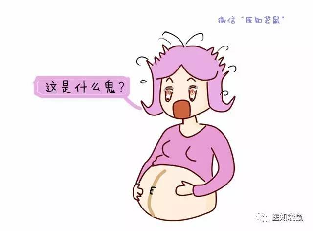 准妈妈肚子上的妊娠线能看出生男生女?