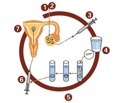 试管婴儿步骤,①②促排卵;③取卵术;④卵子和精子受精;⑤胚胎培养