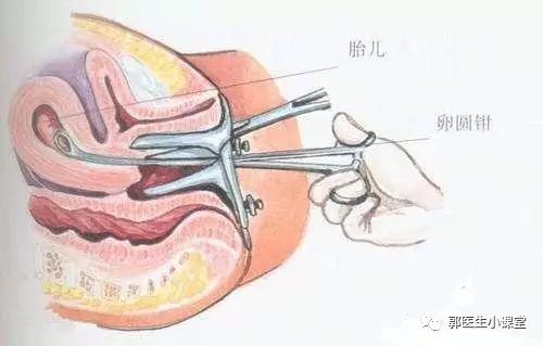 人流后宫颈图片图片