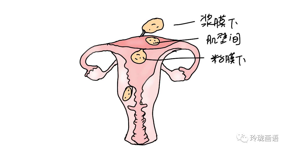 根据与子宫壁的关系分为