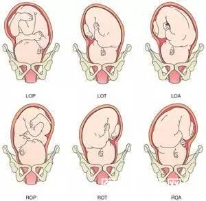 矢状缝,即根据矢状缝与骨盆前后径,横径的关系来判断. 3.