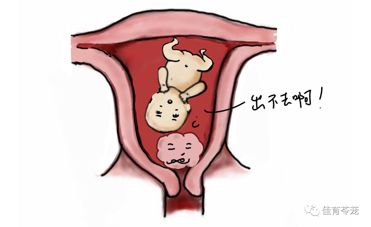 宫腔下段图片