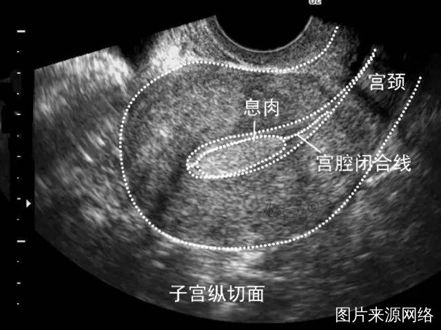 子宫内膜息肉的诊疗指南