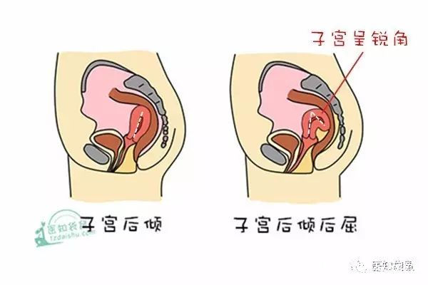 大多数情况下,健康成年女性的子宫是"轻度前倾前屈"的,但也并非绝对.