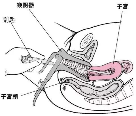 宫颈管长度图片