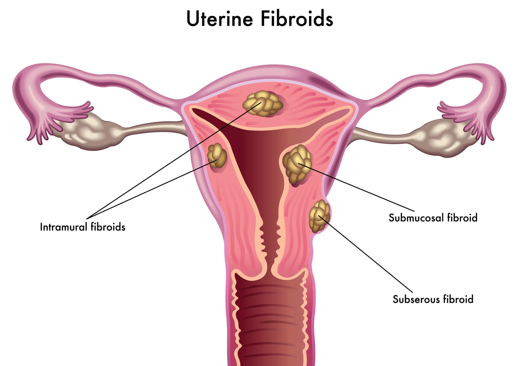 子宫内膜增生早期症状
