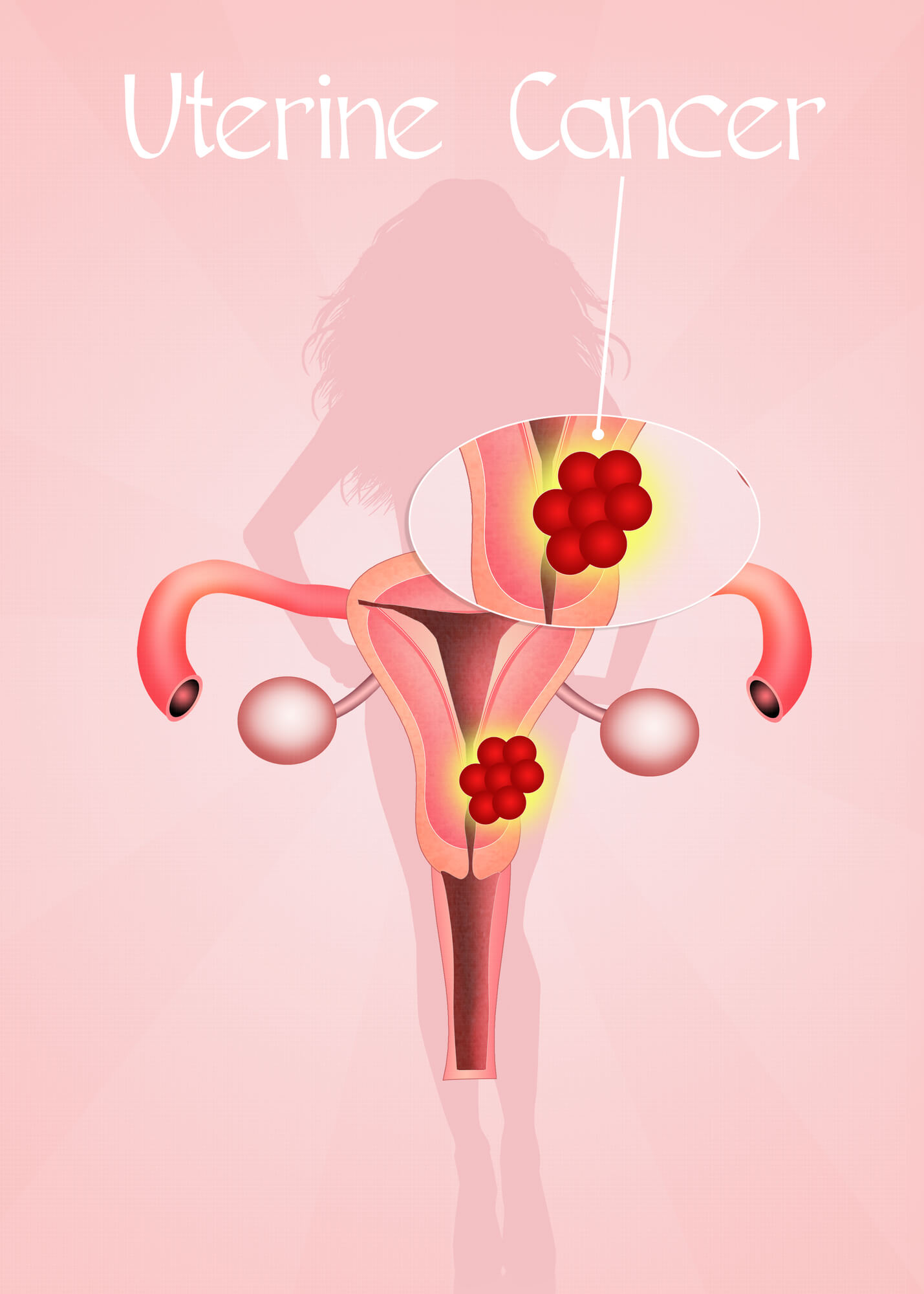 子宫肌瘤剔除后应如何预防宫腔粘连？