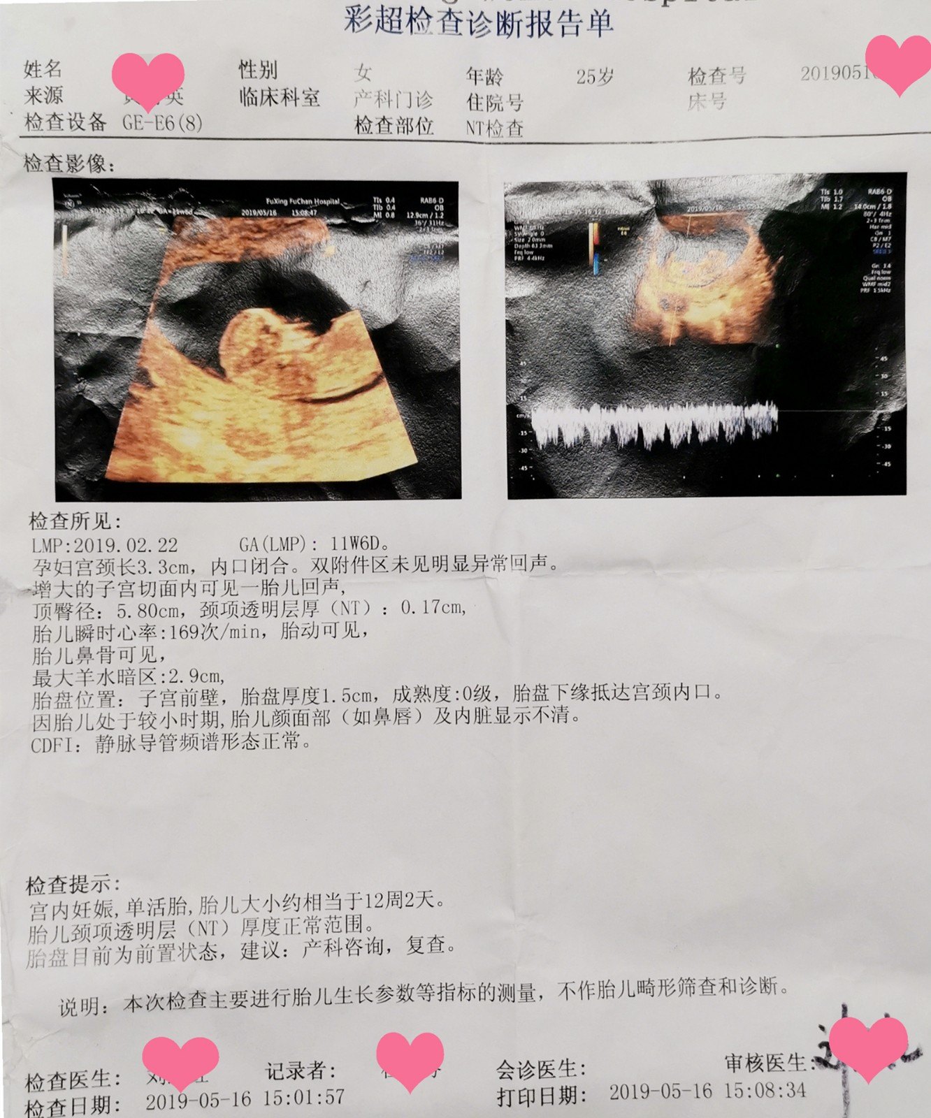 MVE吻合陈姓患者妻子受孕彩超图像_副本.jpg
