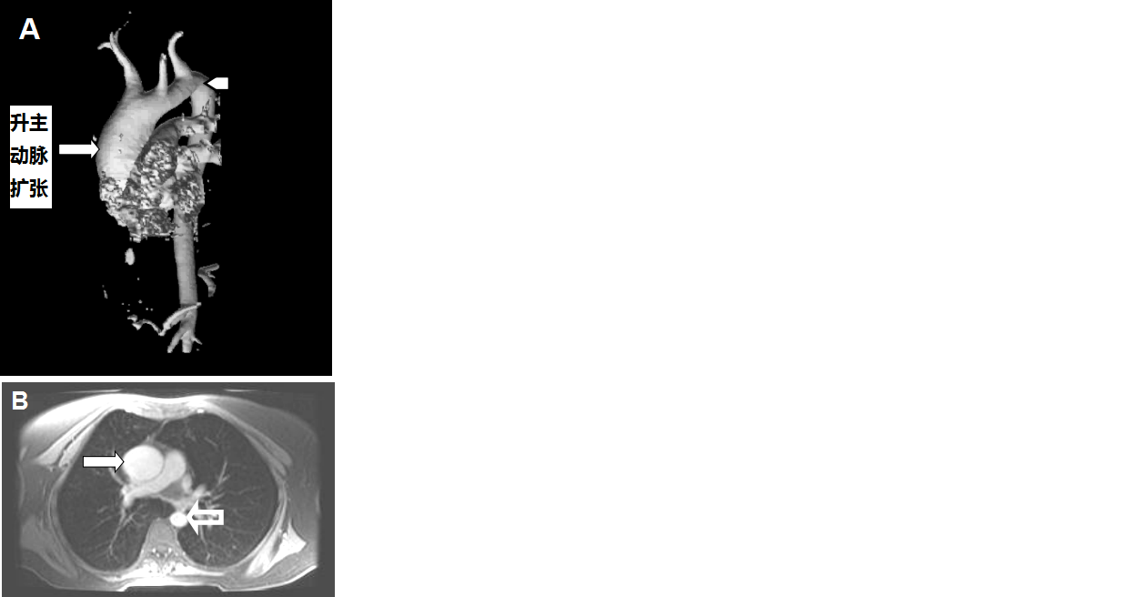dilated ascending ao.png