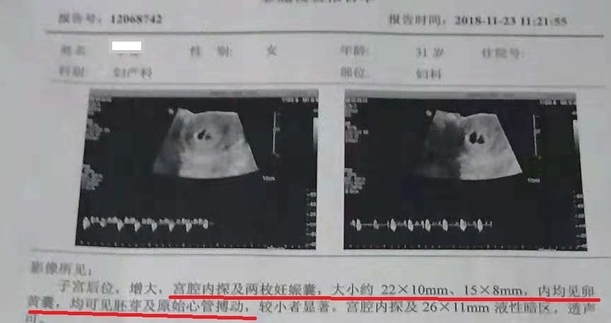 李芬超声20181123.png