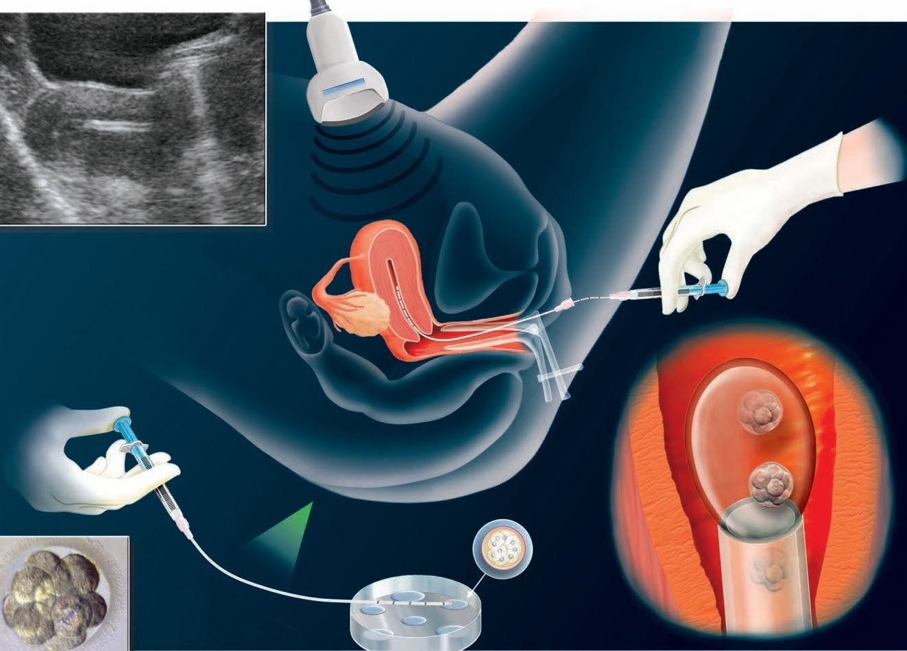 embryo-transfer.jpg