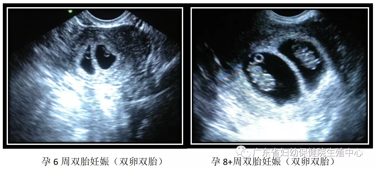单绒毛膜囊双胎图片