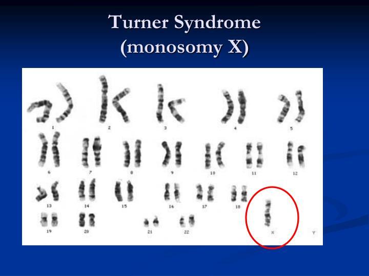 turner-syndrome-monosomy-x-n.jpg