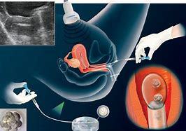 Image result for bed rest after embryo transfer
